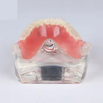 Fogászati fogak vizsgálata Teach Model Overproture Inferior 4 implantátum bemutató modell